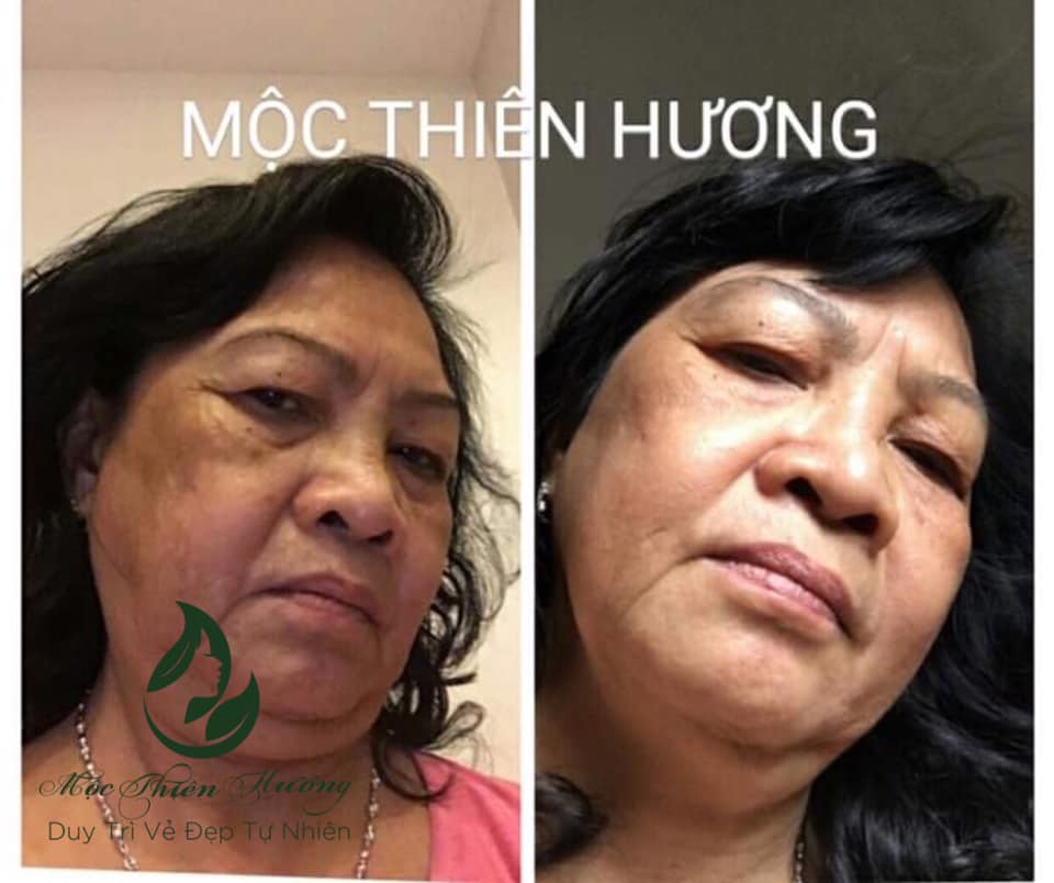KEM NGĂN NGỪA  VÀ XÓA THÂM NÁM MỘC THIÊN HƯƠNG