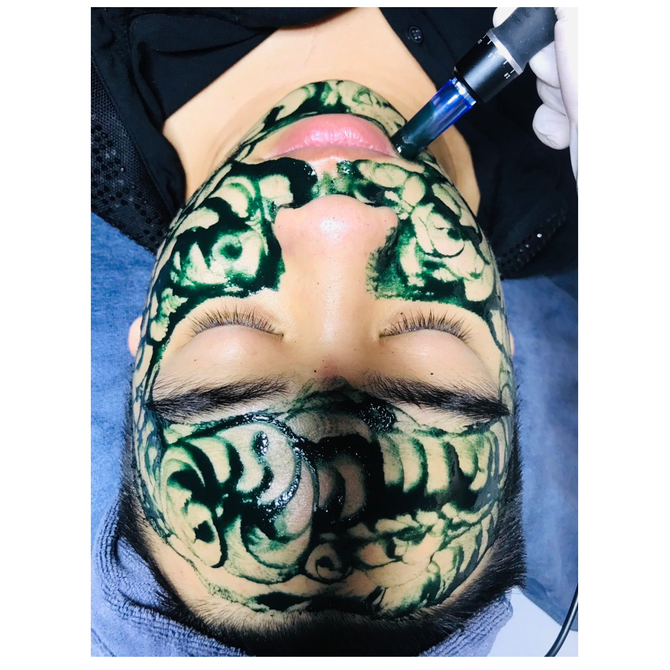 Dory Beauty Spa - Cấy Tảo Xoắn Nhật Bản Tái Tạo Da