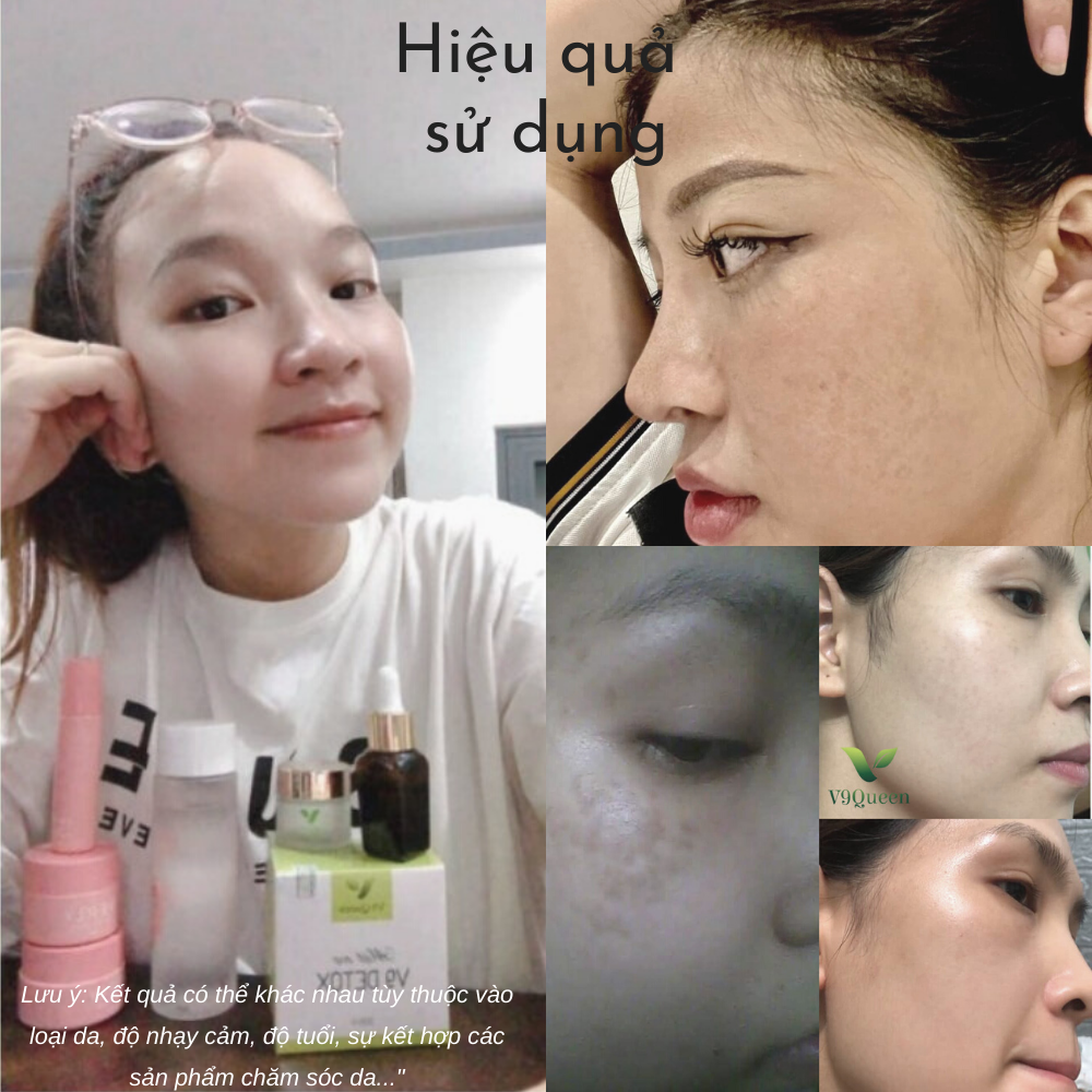Combo 3 Mỹ Phẩm V9Queen Giúp Mờ Nám Tàn Nhang, Dưỡng Trắng Da