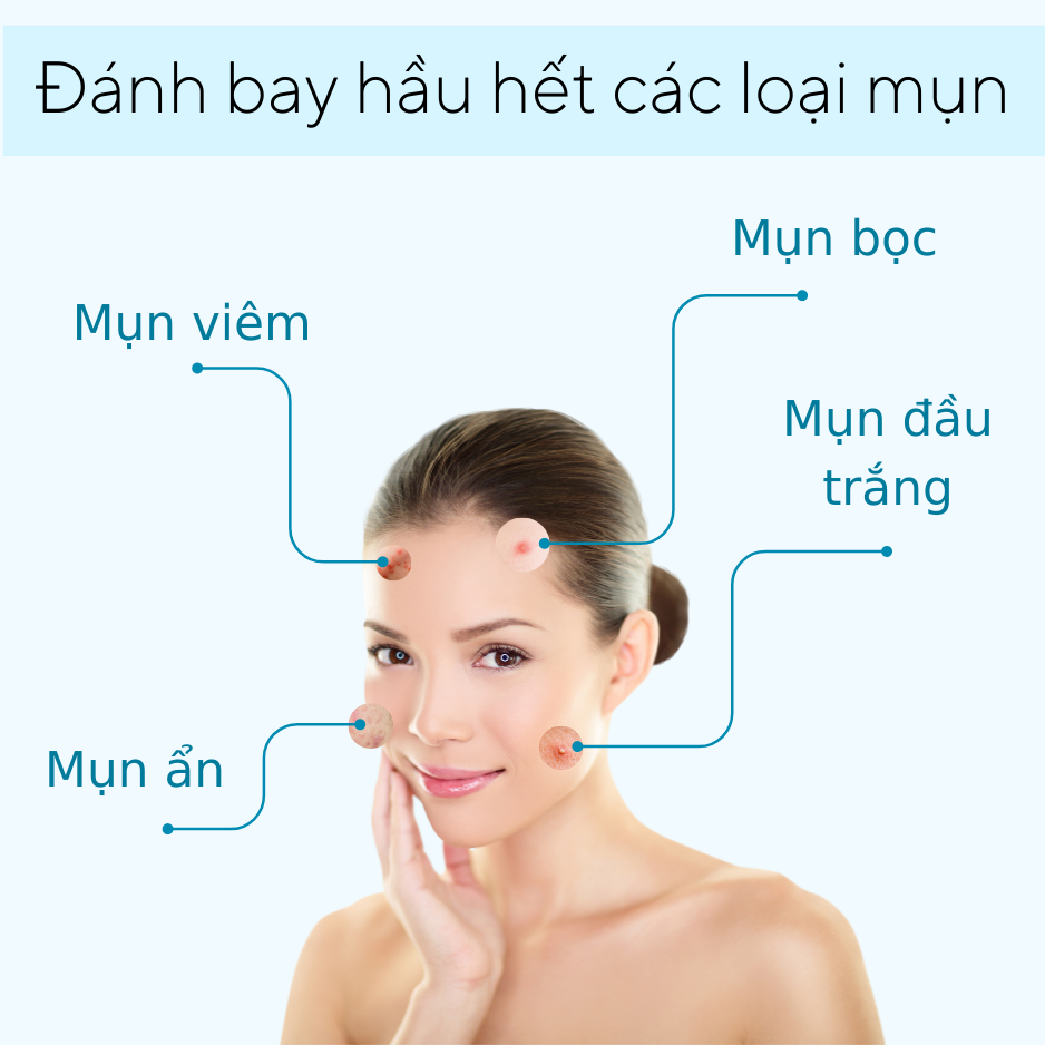 Kem gel bôi mụn Feelex ByeMun thành phần tự nhiên, an toàn, hiệu quả nhanh - Tuýp 15gram