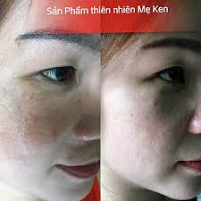 Kem Làm Mờ Nám và Tàn Nhang Mẹ Ken 30ml