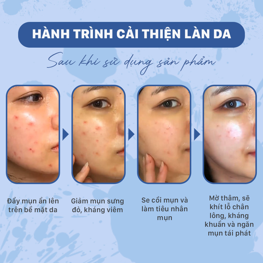 Bộ sản phẩm giảm mụn và ngăn ngừa mụn chuyên sâu OMUSE Blemish Solution Acne Correcting set