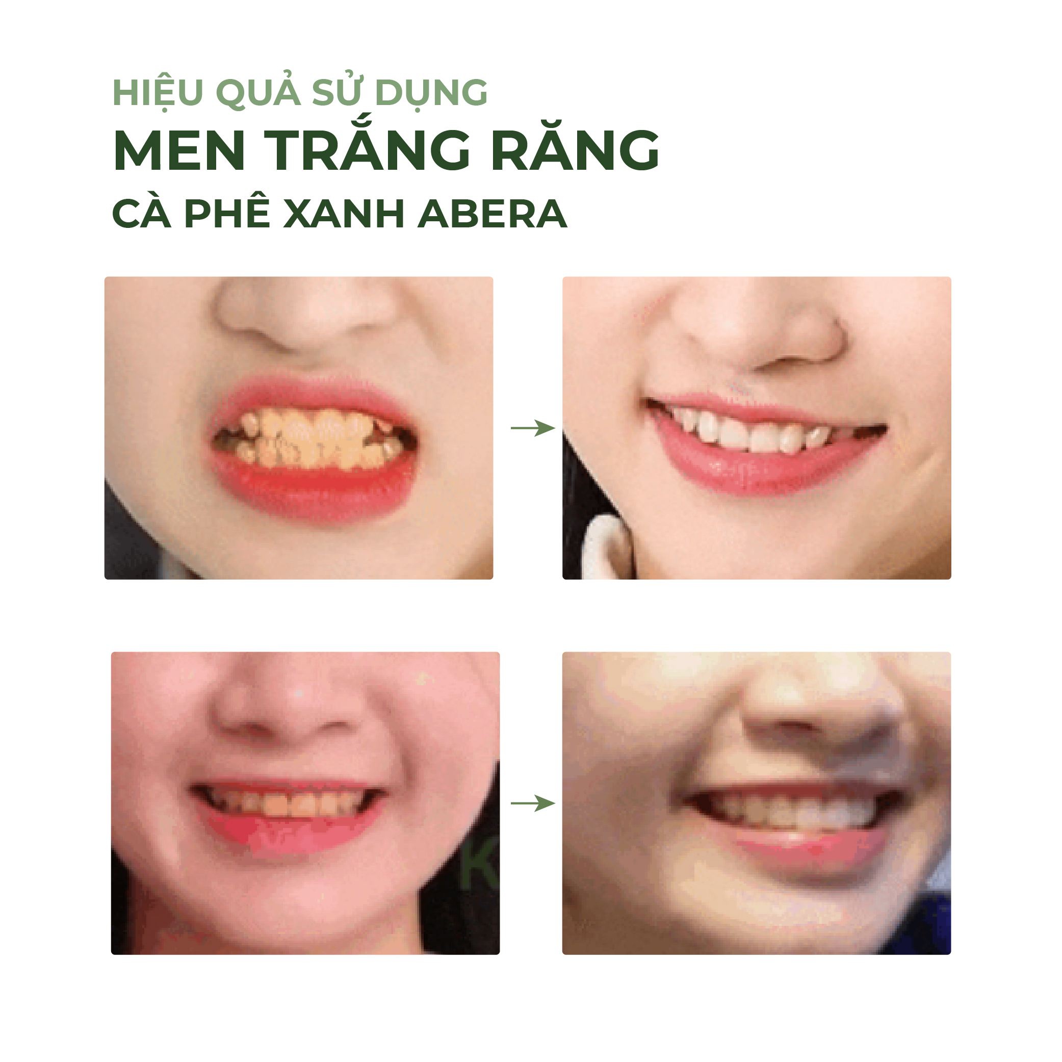 Men Trắng Răng Kagami Abera Khắc Phục Mọi Vết Ố Vàng Trên Răng Và Giúp Răng Trắng Sáng Tự Tin
