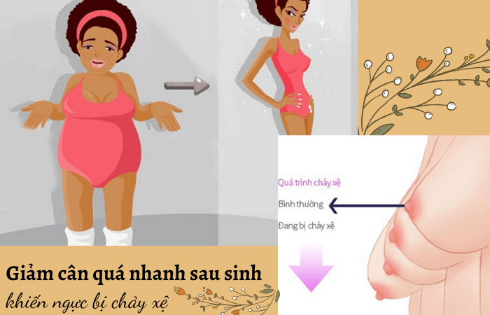 Nguyên nhân ngực chảy xệ