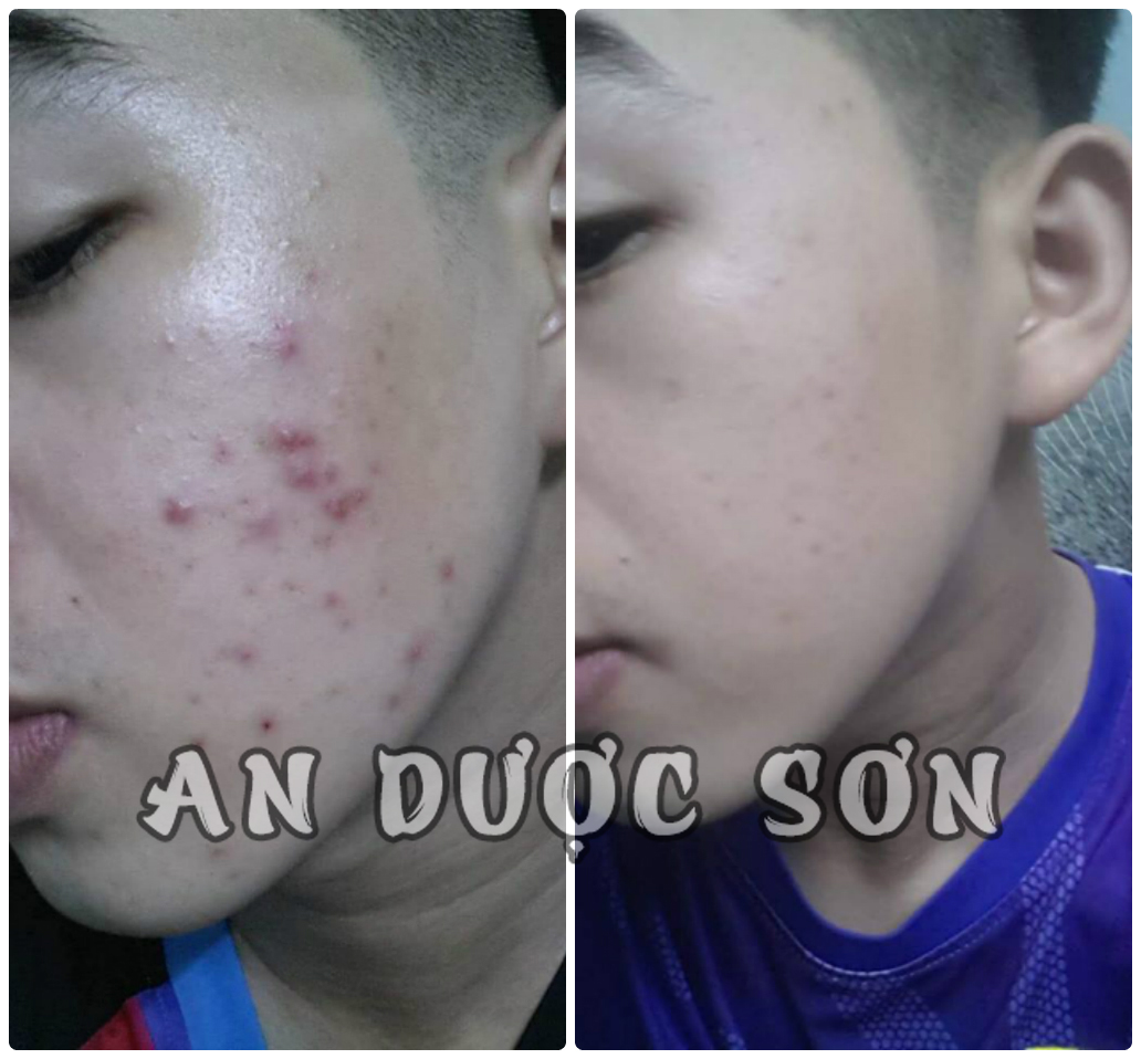 Serum ngừa mụn thâm sẹo rỗ An Dược Sơn 50ml & Bột rửa mặt an dược sơn