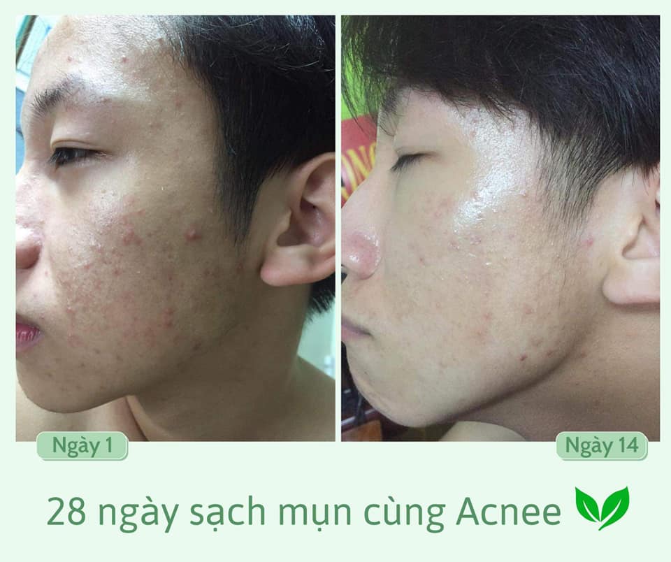 Acnee Lotion - Dưỡng Ẩm Và Làm Dịu Làn Da