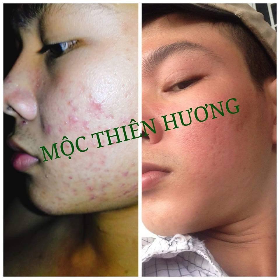 Serum Ngừa Mụn, Giảm Thâm, Dưỡng Sáng, Se Khít Da Từ Serum Thảo Mộc 50ml | Mộc Thiên Hương