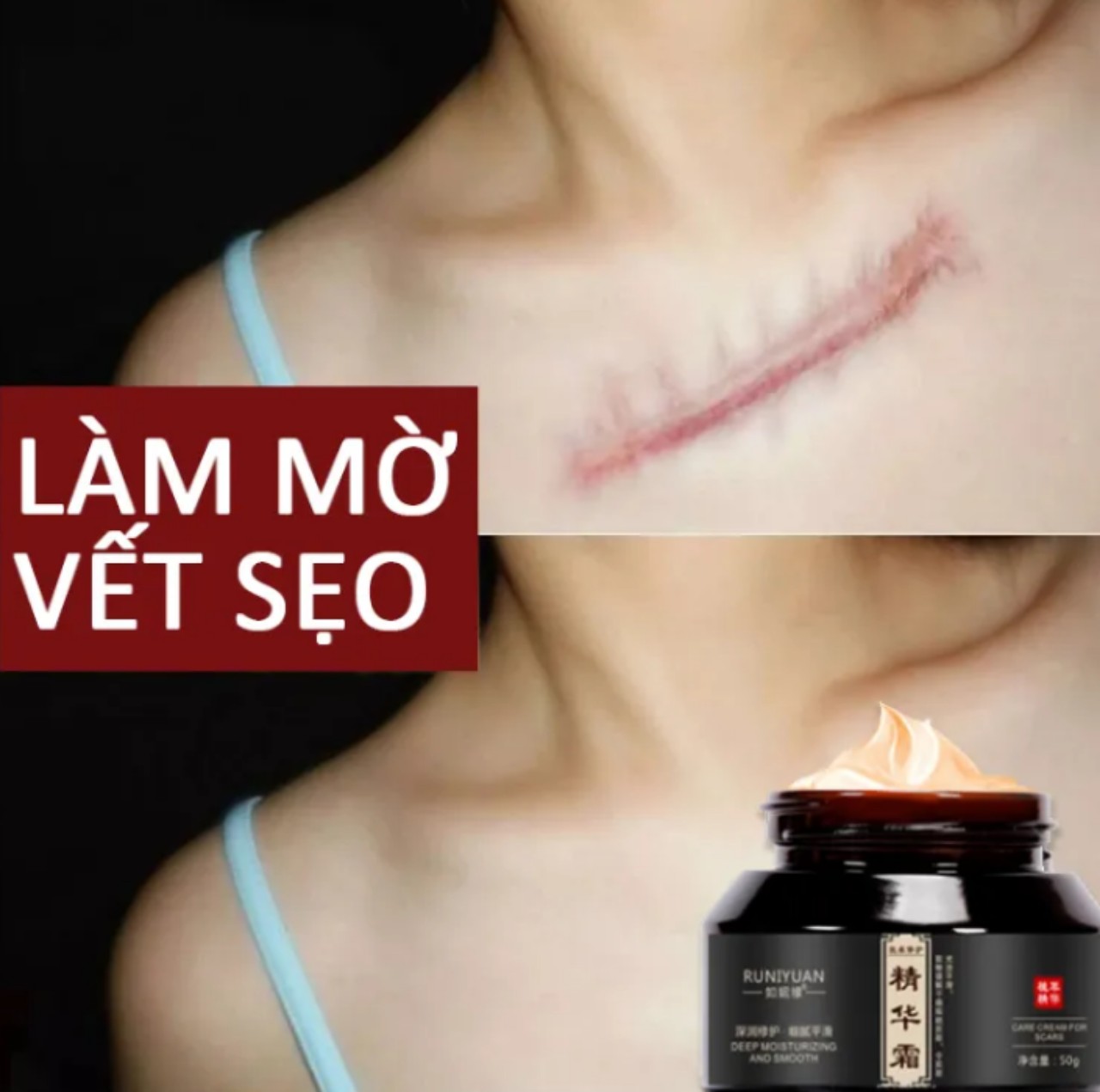 Kem xóa sẹo làm mờ sẹo hàng cao cấp