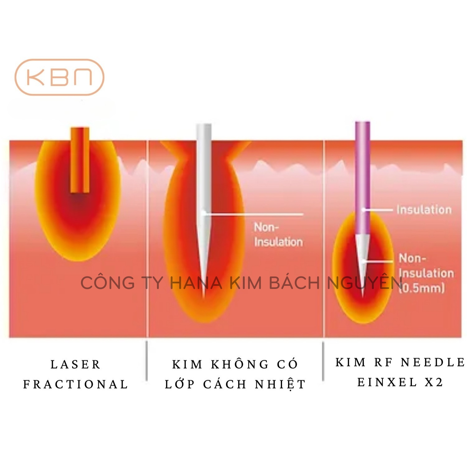 Máy RF Vi Điểm EINXEL X2 Giảm Nếp Nhăn, Thu Nhỏ Lỗ Chân Lông, Vết Rạn Da, Trị Sẹo