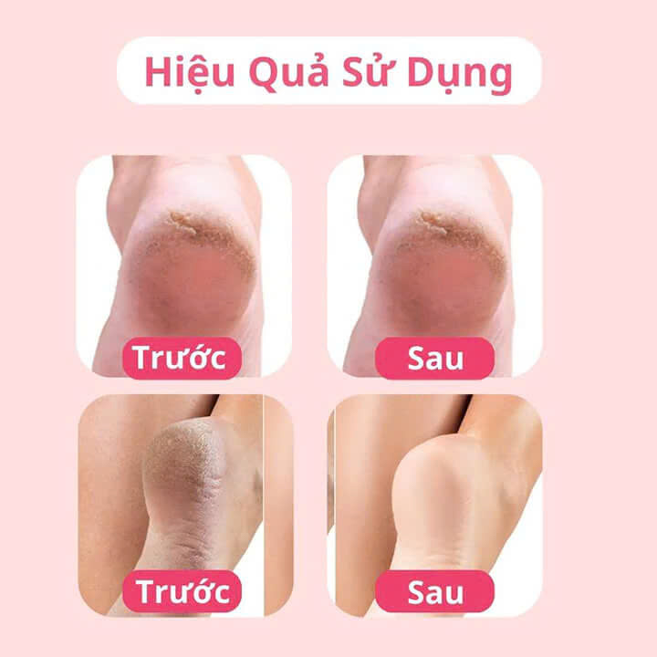 Máy Chà Gót Chân Tự Động Loại Bỏ Da Sần Chai Gây Đau, Xoá Chai Chân Hiệu Quả – Cho Gót Hồng Mềm Mịn Như Em Bé