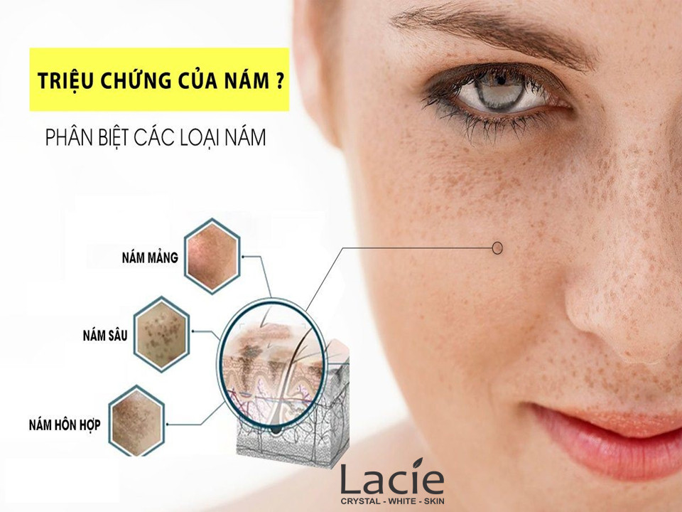 KEM NGĂN NGỪA NÁM NỘI TIẾT &amp; NGOẠI TIẾT - SUPER ANTI MELASMA