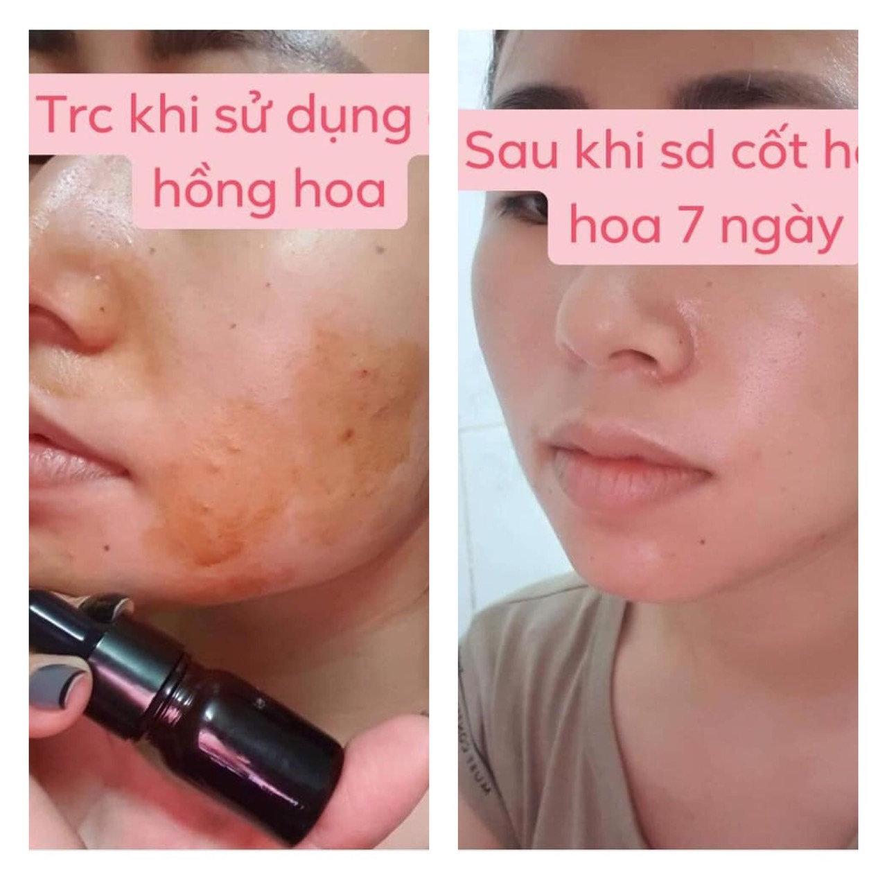 Kem giảm mụn, thâm cốt hồng hoa Rova (combo 2 lọ)