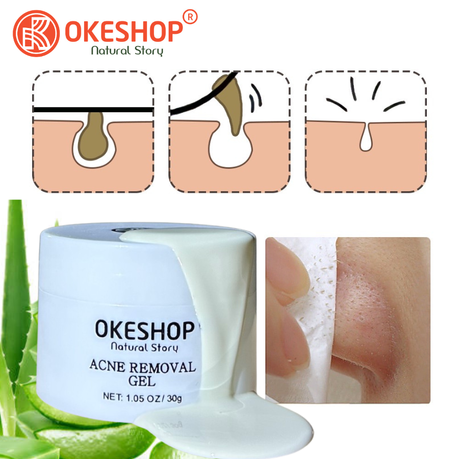 Gel Lột Mụn Nha Đam OKESHOP 30ml - Giải Pháp Loại Bỏ Mụn Đầu Đen - Mụn Cám - Bạ Nhờn - Làm Sạch Sâu Và Thu Nhỏ Lỗ Chân Lông