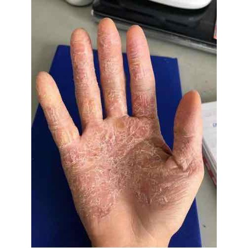 Thảo dược bôi nấm ngứa, tổ đỉa, hắc lào, lang ben, vảy nến, á sừng, zona các vấn đề về da_1 hộp 20 gói