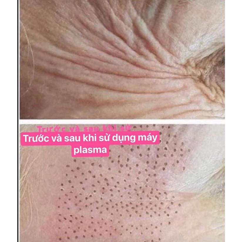 Máy Nhấn Mí Plasma Dùng Trong Spa