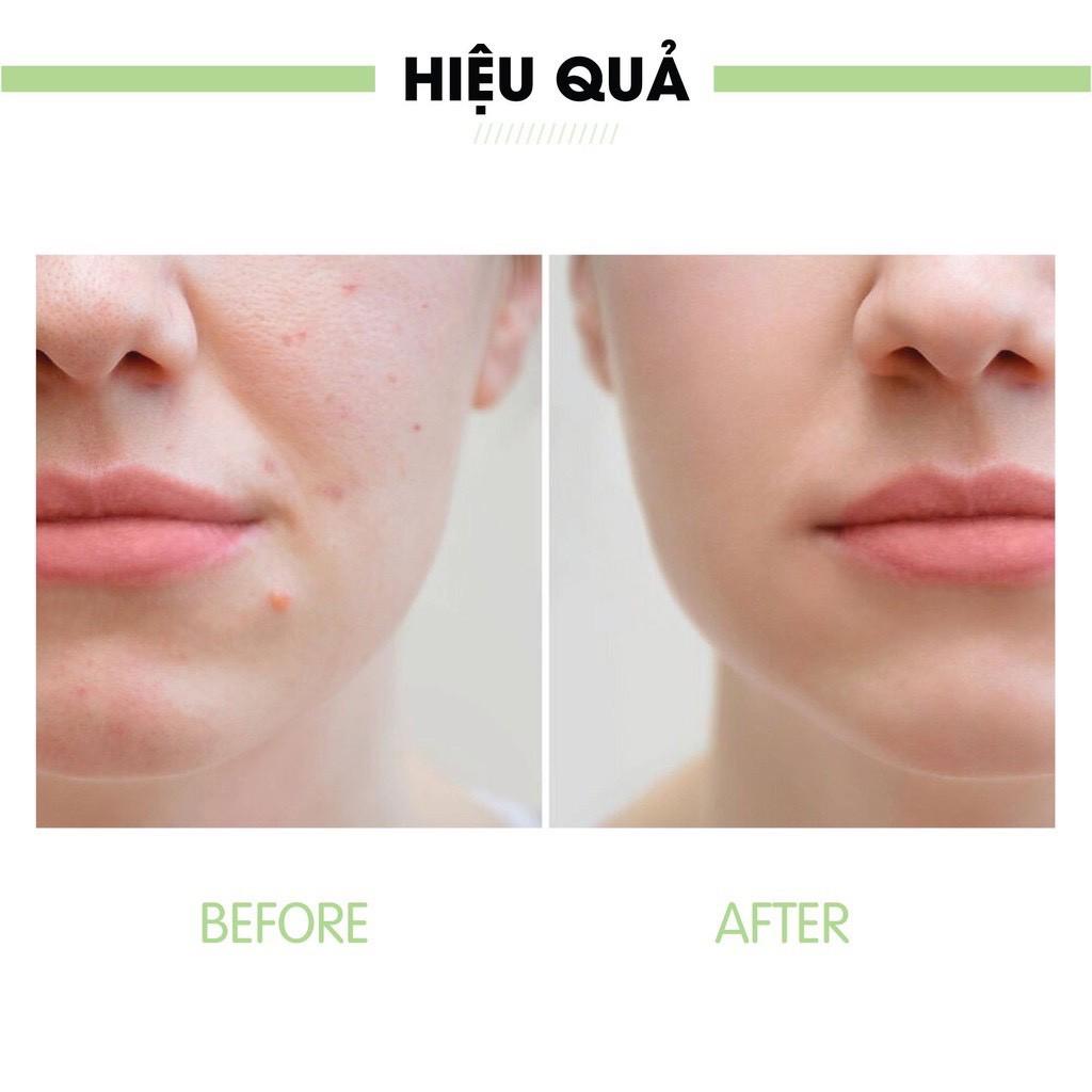 Bộ sản phẩm ngừa mụn Acosmetics: Kem Ngừa và Giảm Mụn + Sữa rửa mặt trà xanh X2