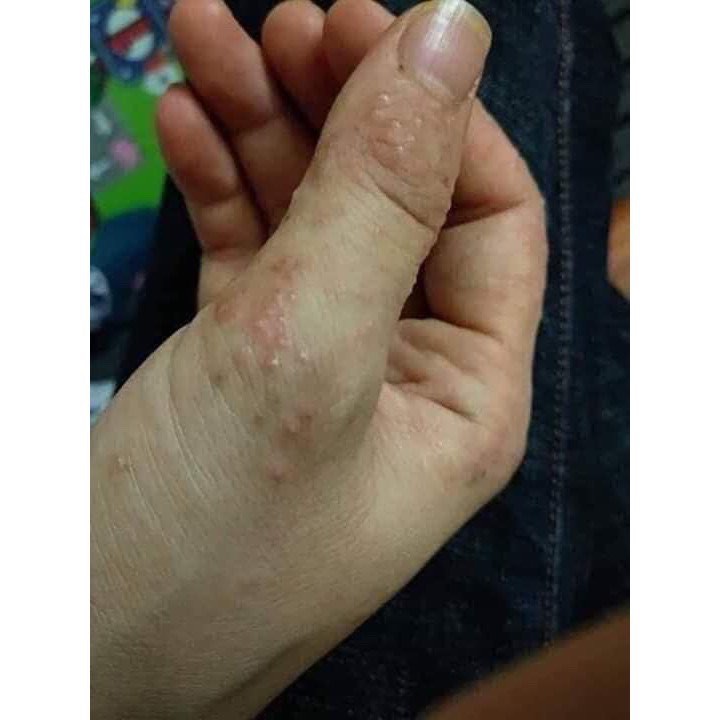Thảo dược bôi nấm ngứa, tổ đỉa, hắc lào, lang ben, vảy nến, á sừng, zona các vấn đề về da_1 hộp 20 gói