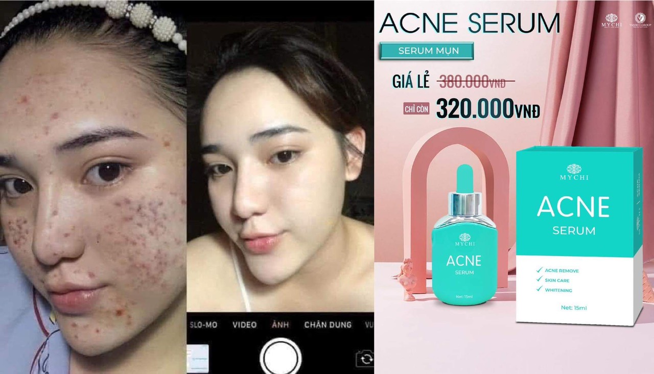 Serum mụn ACNE Mychi