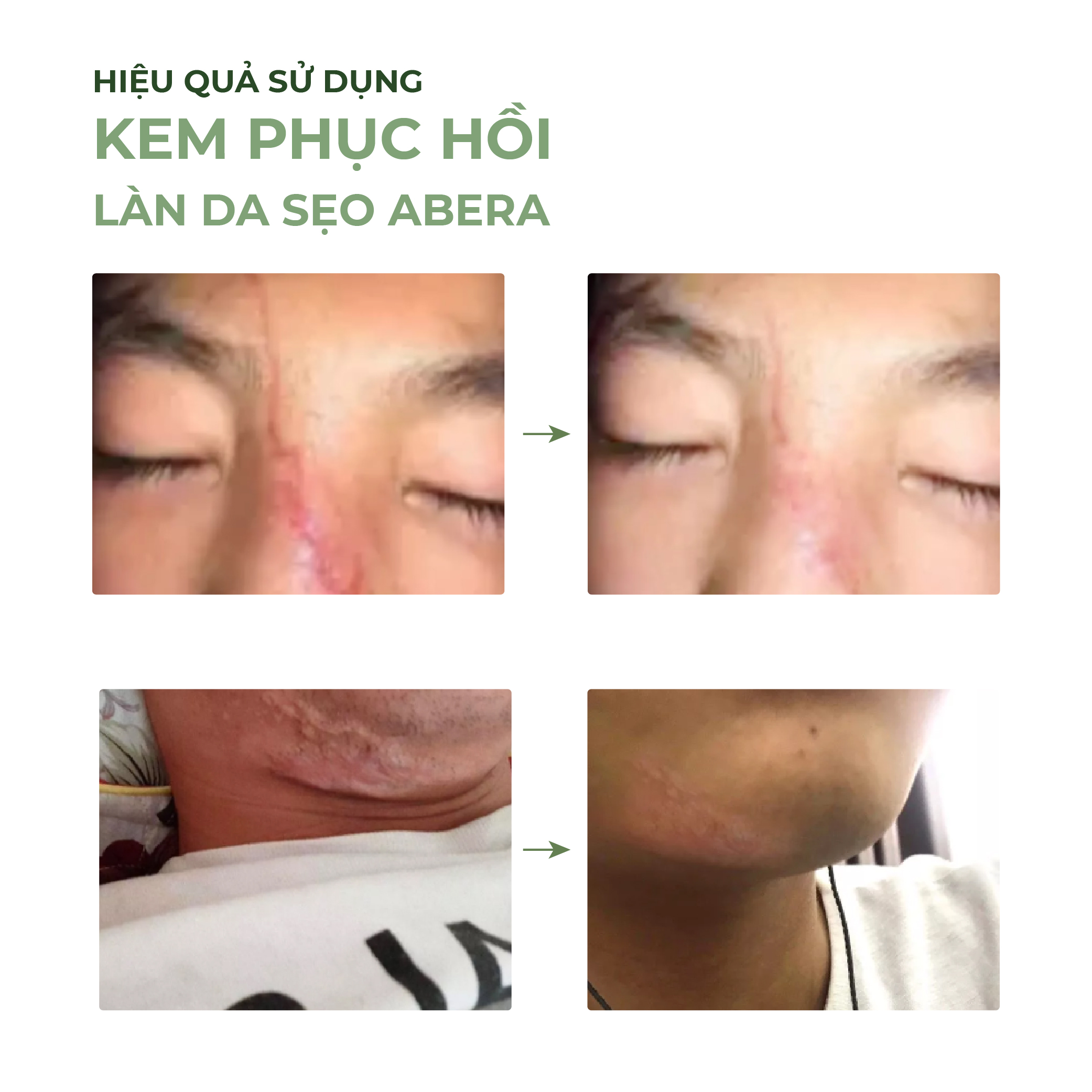 [Combo 2] Kem Sẹo Nghệ Đỏ Abera Scar 20g Phục Hồi Làn Da bị Sẹo An Toàn Hiệu Quả, Nhanh Chóng