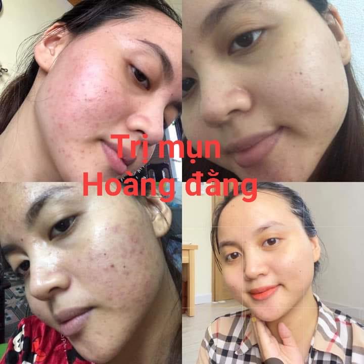 Tinh Chất Hoàng Đằng MẸ KEN 10ml- Serum mụn (bọc, mủ, sưng, viêm, dị ứng...)