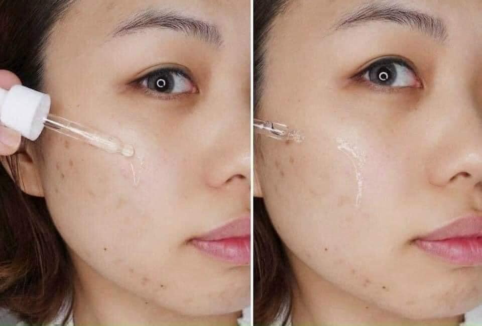 Sét Serum Giảm Mụn Nhanh Lành Tính HONESI Acne Treatment Ampoule - Hàn Quốc