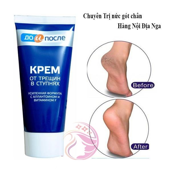 Kem dưỡng ngăn ngừa nứt gót chân Kpem Cream for Carcks in the feet 50ml