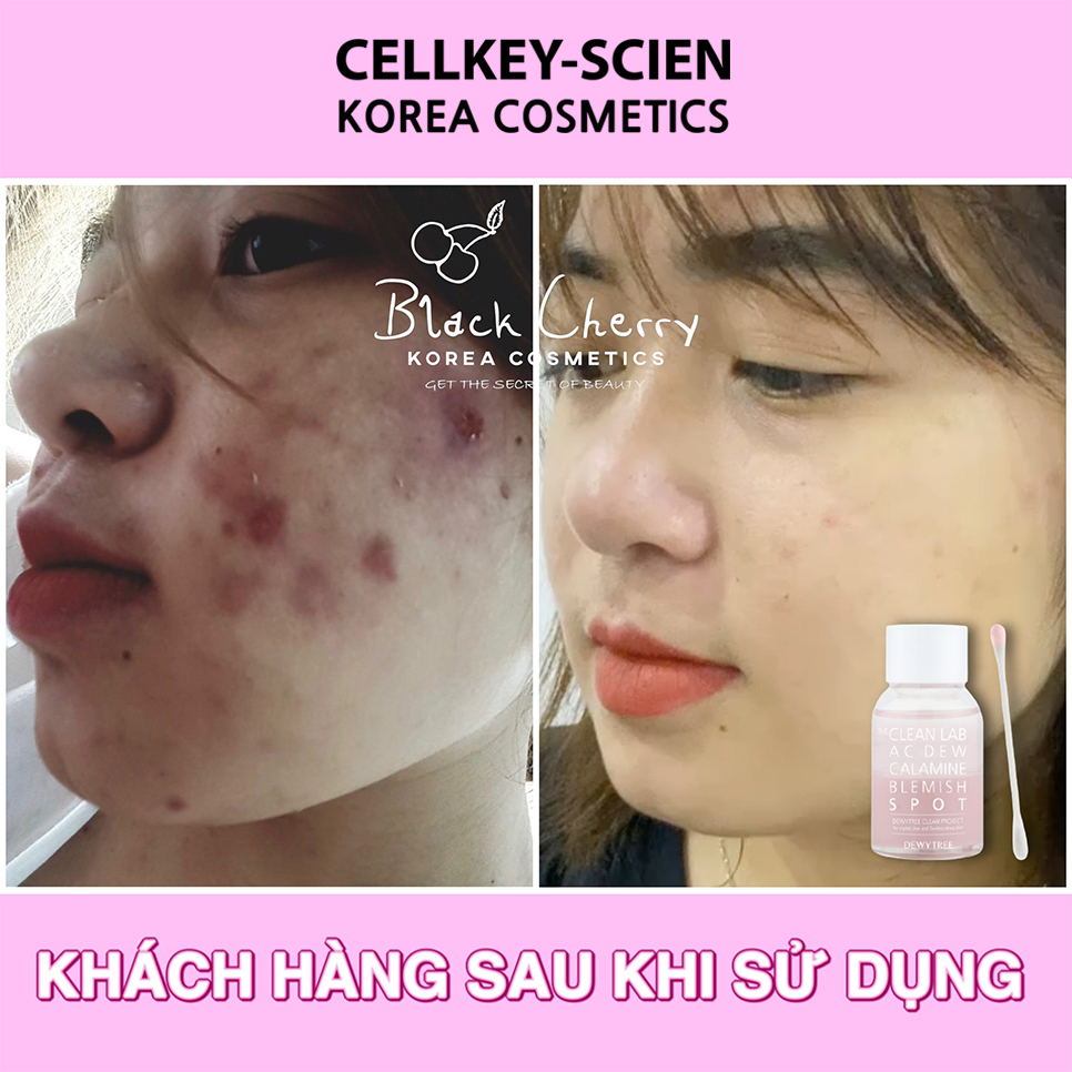 Serum Tinh Chất Chấm Mụn Lành Tính Nhanh Xẹp Mụn Chống Thâm Và Sẹo Rỗ DewyTree The Clean Lab AC DEW Calamine Blemish Spot 20ml