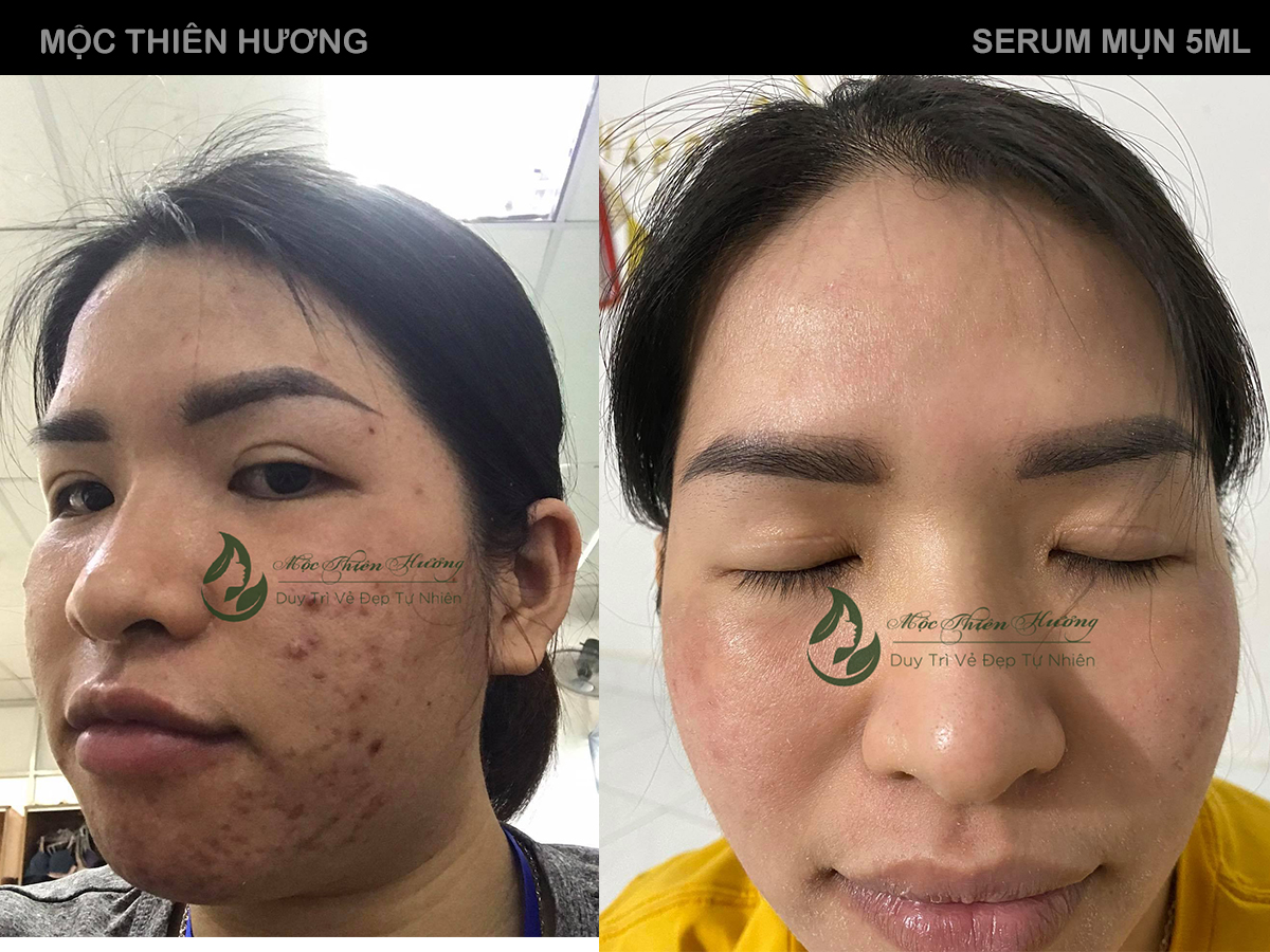 Serum 14 Ngày Hết Mụn Sạch Thâm Không Bong Tróc Không Sưng Đỏ - Mộc Thiên Hương