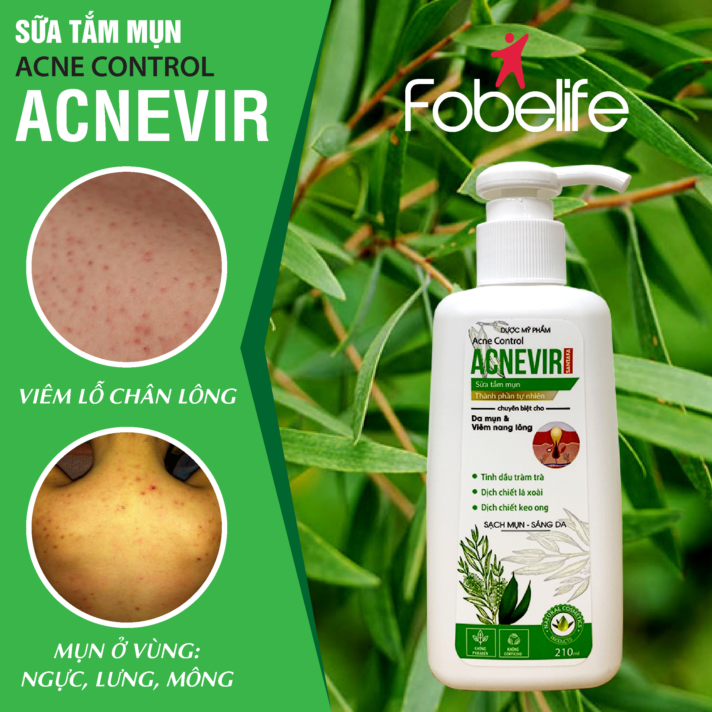 {Combo} : 1 Sữa tắm chuyên biệt cho mụn lưng &amp; bệnh viêm nang lông Acnevir TẶNG 1 dải tắm- Chai 210ml