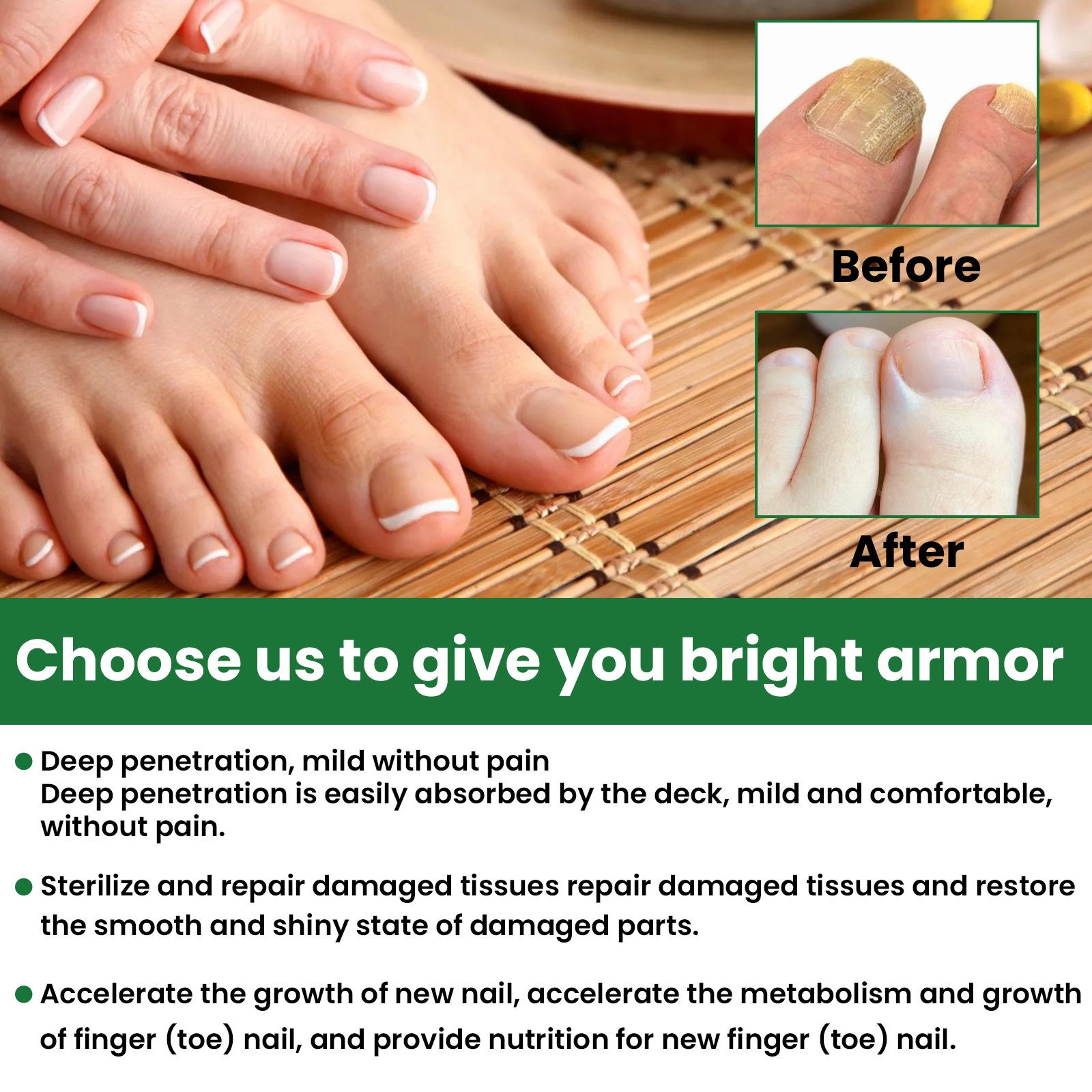 EELHOE 30ml Nail Treatment Essence for Onychomycosis Mild Non-irritating Nail Bright Shiny Repair Nail Repair Solution