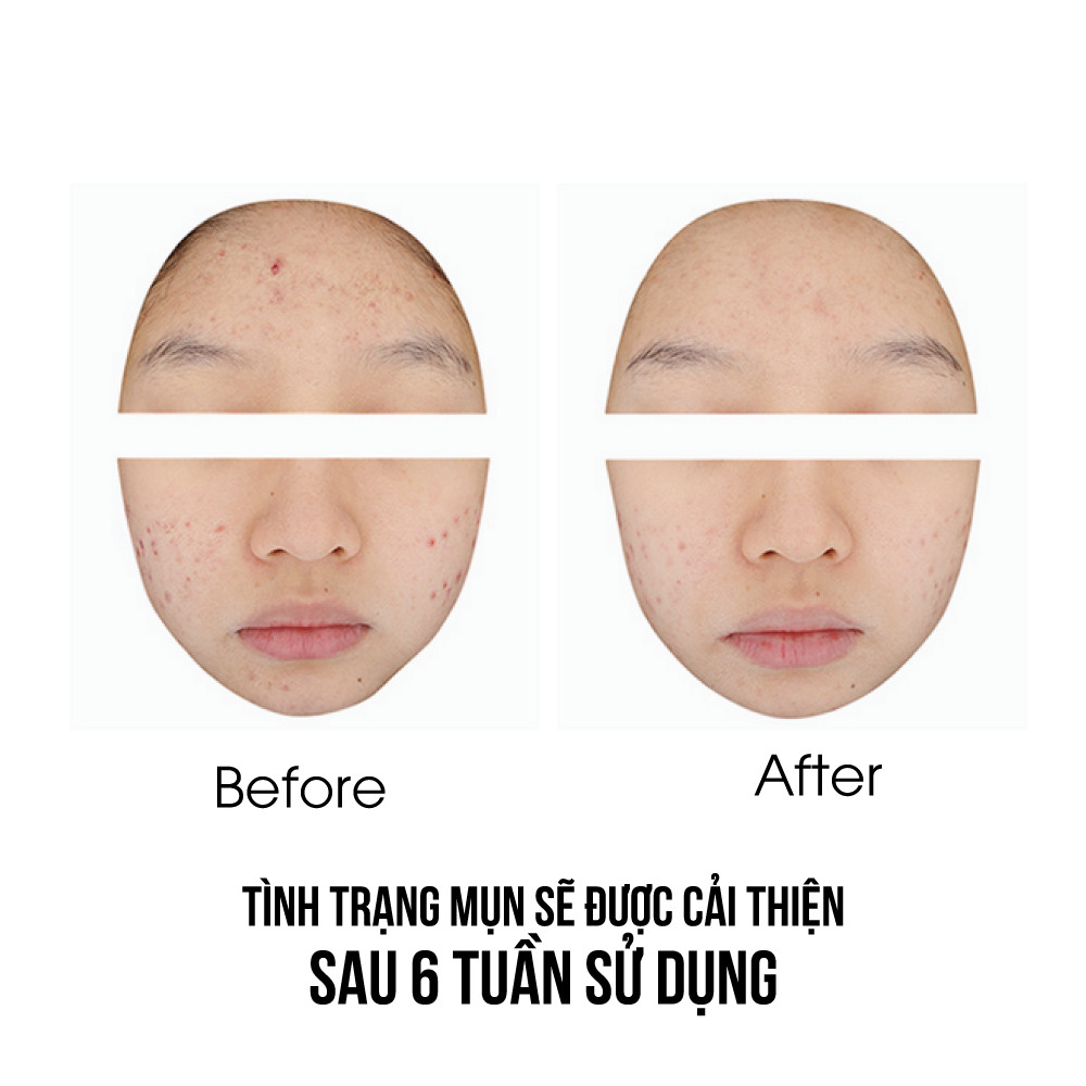 Tinh chất dưỡng da mụn AMPLE:N Amplen Acne Shot Ampoule 30ml