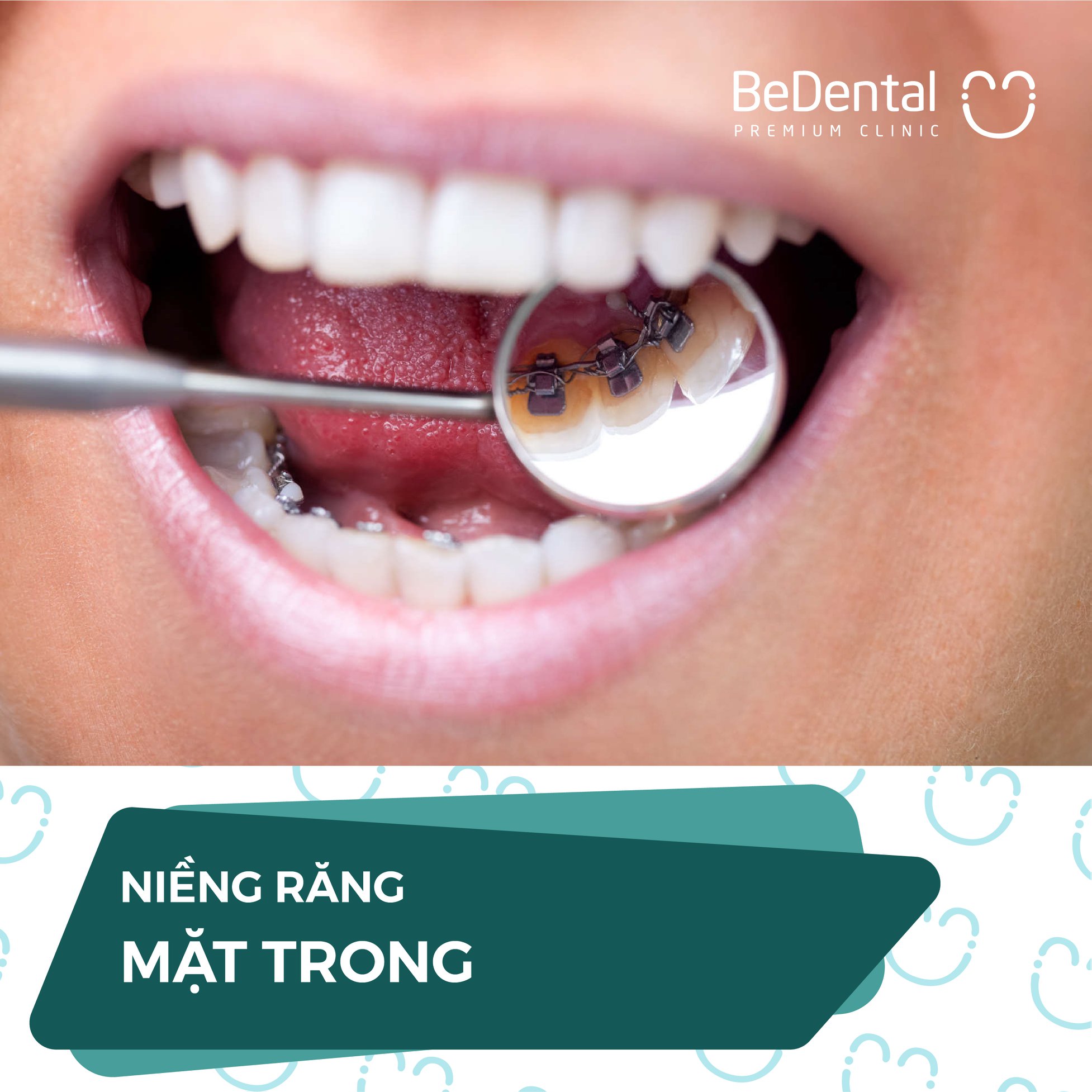Voucher Niềng răng - Nha khoa BeDental - 5 chi nhánh