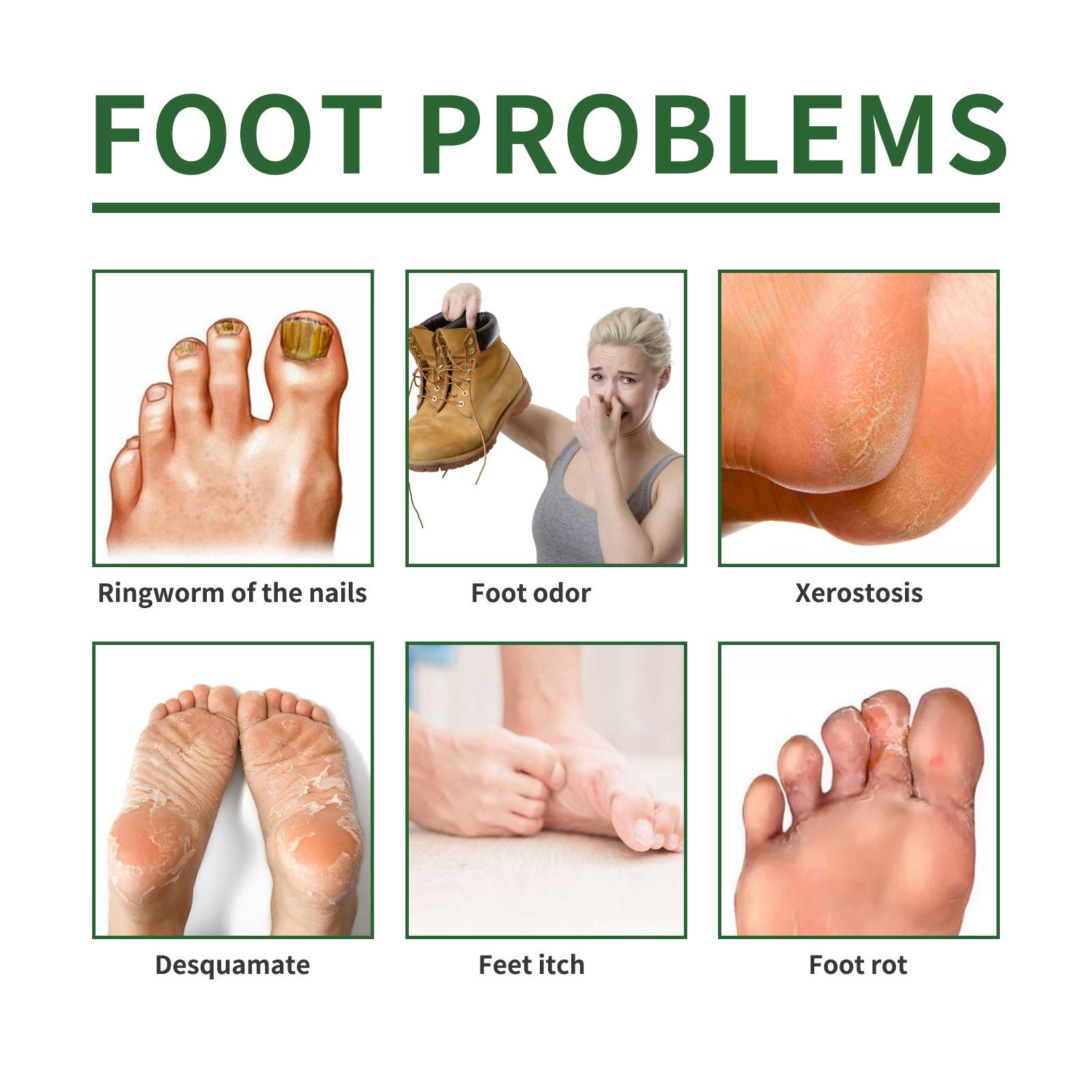 South Moon Nail Repair Foot Mask Manicure Repair Onychomycosis Bright Nail Foot Cracked Exfoliation