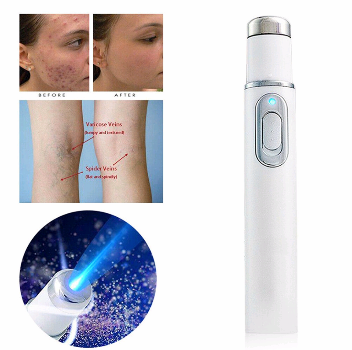 1 BÚT MÁY XÓA MỤN BẰNG TIA LASER ÁNH SÁNG XANH THÔNG MINH HIỆU QUẢ CÔNG NGHỆ MỚI SỬ DỤNG CHO NAM NỮ TIỆN DỤNG HÀNG CAO CẤP