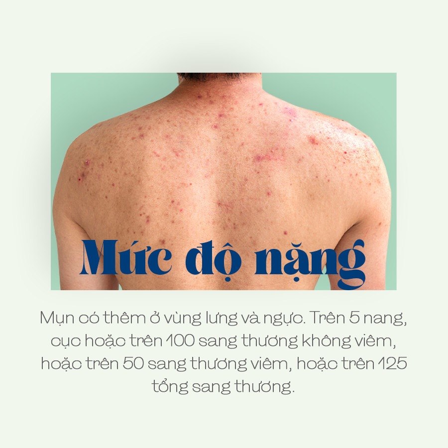 LIỆU TRÌNH CHĂM SÓC DA MỤN NẶNG NÂNG CAO