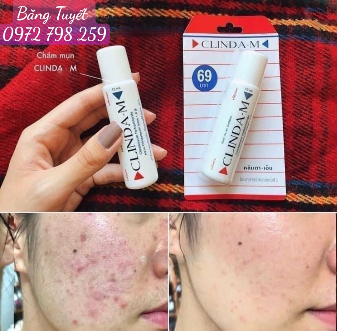 Serum Chấm Loại Bỏ Mụn CLINDA-M 15ml Thái Lan