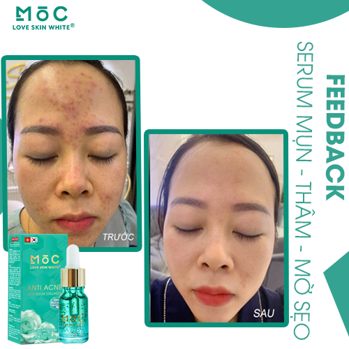 Serum Ngừa Mụn Thâm, Mờ Sẹo 10ml MỘC