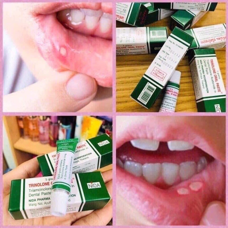 Kem bôi nhiệt miệng .Kem nhiệt miệng Trinolone Oral Paste Thái Lan 5gr