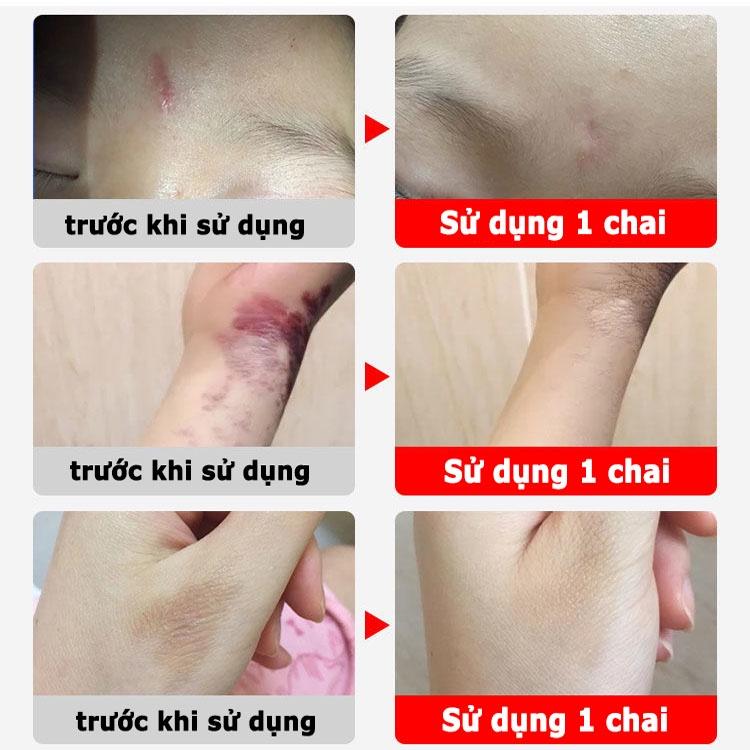 Kem xóa sẹo, loại bỏ hiệu quả các vết sẹo lâu năm, sẹo phẫu thuật, phục hồi và làm sáng các vết rạn da khi mang thai, xó