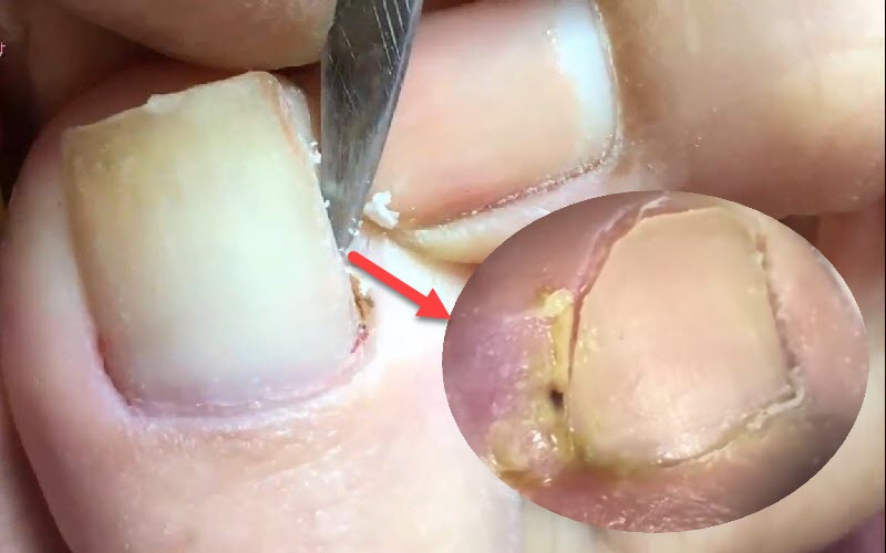 Thảo dược bôi nấm ngứa, tổ đỉa, hắc lào, lang ben, vảy nến, á sừng, zona các vấn đề về da_1 hộp 20 gói
