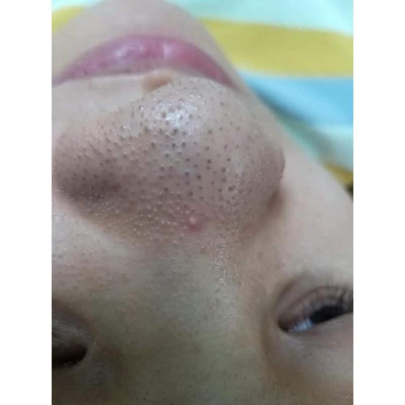 10 tuyp lột mụn ance