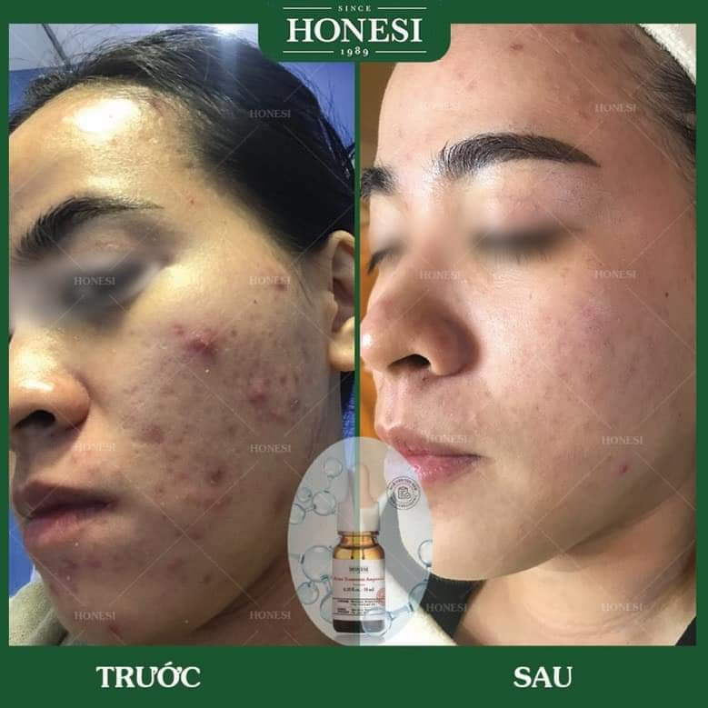 Sét Serum Giảm Mụn Nhanh Lành Tính HONESI Acne Treatment Ampoule - Hàn Quốc
