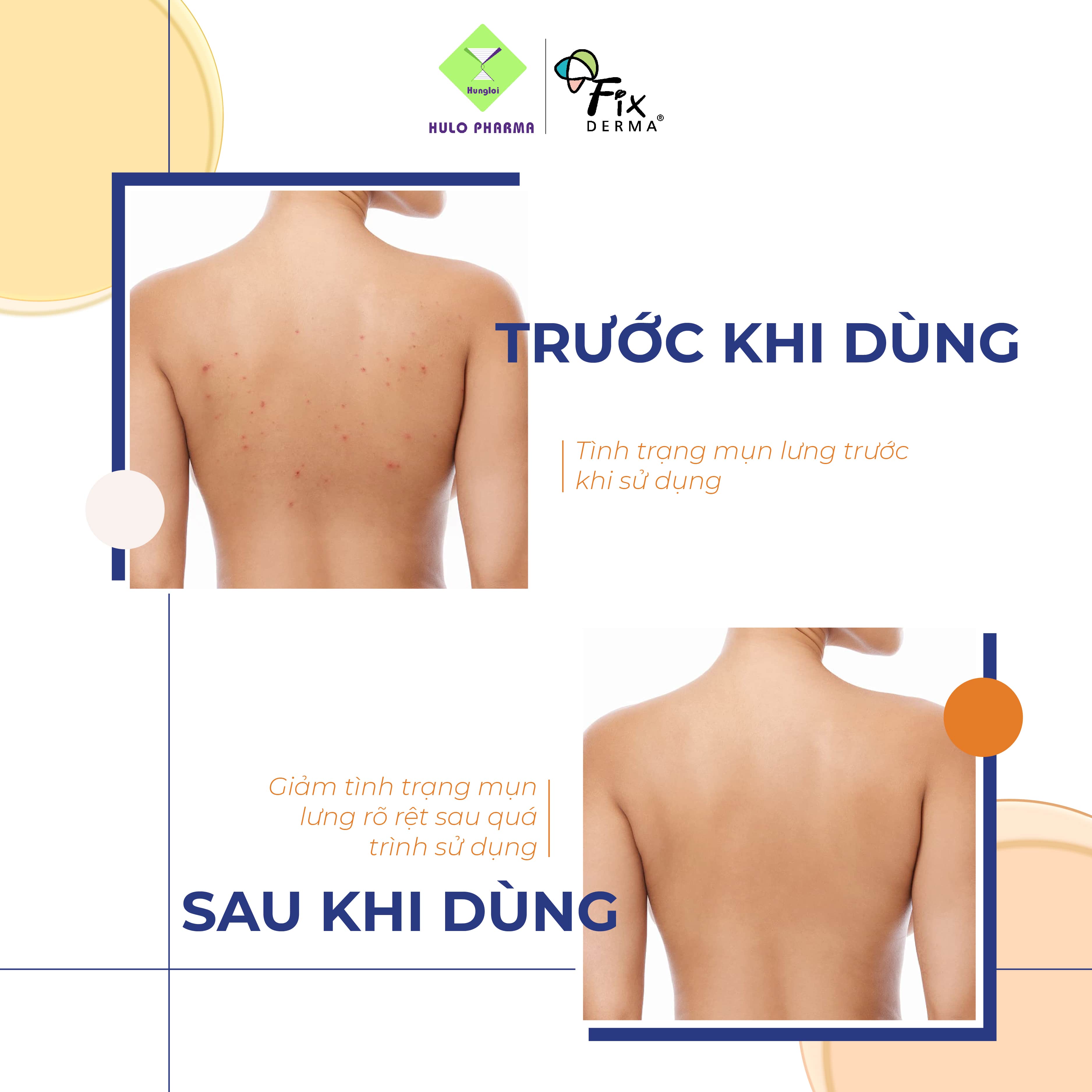 Xịt Mụn Lưng FIXDERMA Salyzap For Body Spray Ngừa Mụn, Giảm Viêm, Ngăn Dày Sừng Nang Lông Giúp Da Sáng Mịn, Giảm Thâm Mụn 50ml