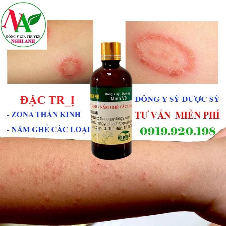 Thảo mộc bôi Zona thần kinh, nấm ghẻ, nước ăn chân tay hiệu quả Đông Y Nghi Anh Lọ 100ml