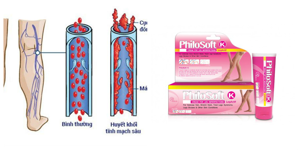 PHILOSOFT LEGBEAU CREAM  KEM GIÃN TĨNH MẠCH 25g