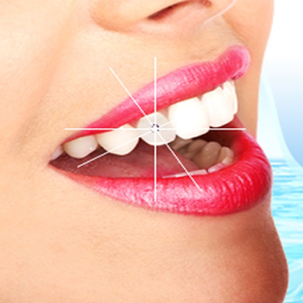 Đính Đá Răng Thẩm Mỹ - Nha Khoa Gia Hân