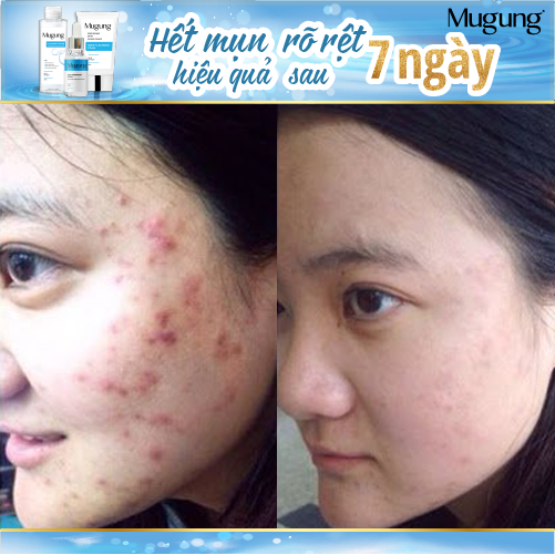 Serum Hoặc Nước Tẩy Trang giảm mụn Mugung 7 ngày hiệu quả giảm mụn đầu đen,mụn bọc (Làm xẹp không bong da)Acne Treatment