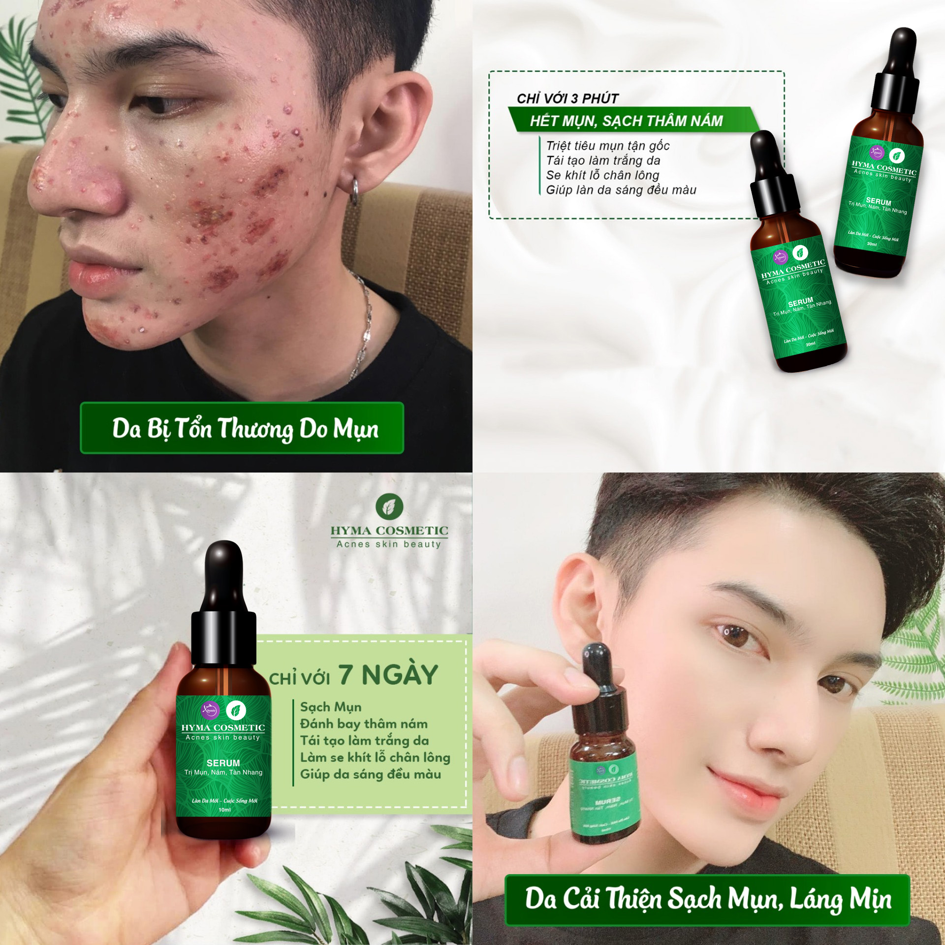 Serum ngừa mụn nám sẹo thâm rỗ tàn nhang XBeauty Hyma Acnes (30ml/10ml). Dòng kem ngăn ngừa mụn thâm sẹo rỗ