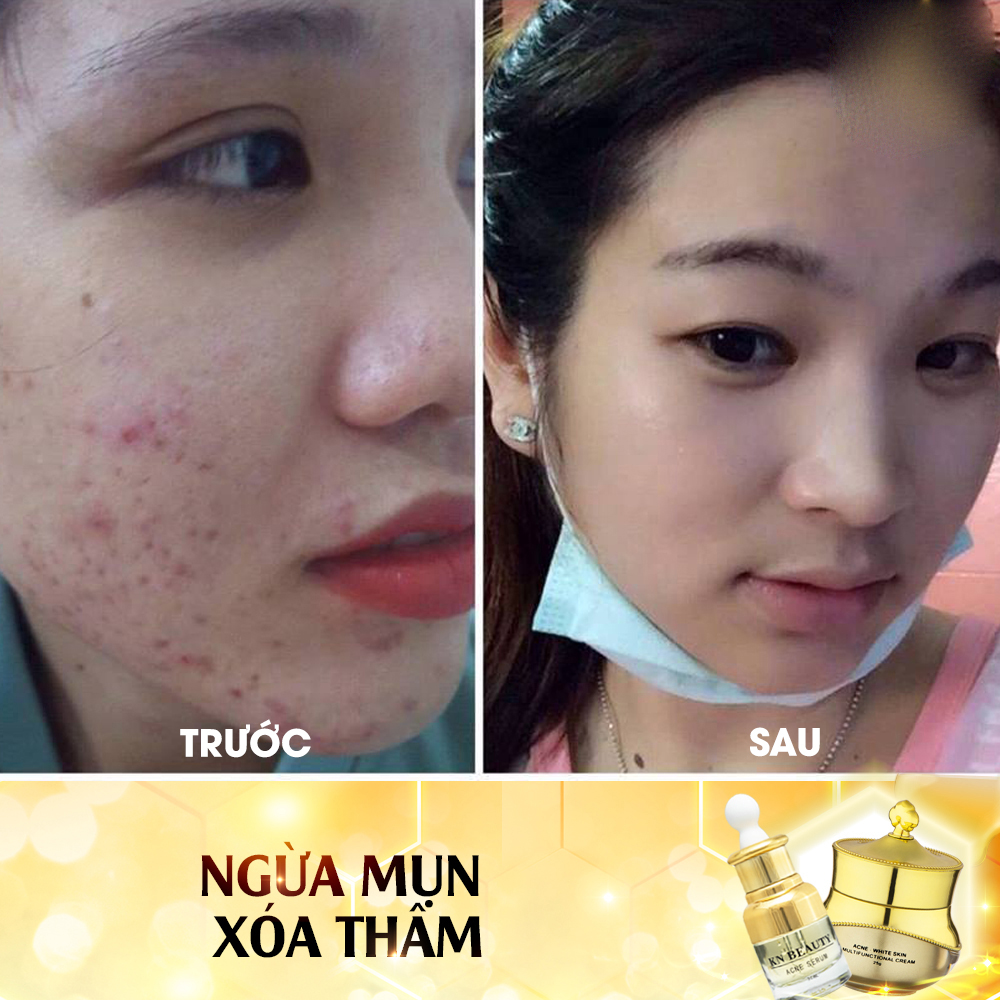 Bộ 2 sản phẩm Trắng Da Ngừa mụn KN Beauty chuyên sâu: Kem dưỡng 25g + Serum 30ml - Quà Tặng Mặt Nạ