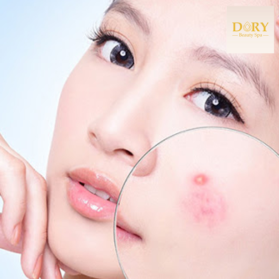 Dory Beauty Spa - Combo Trị Mụn CO2 CORBONTHERAPY